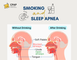 Alcohol and Sleep Apnea