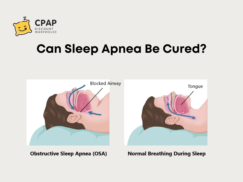 Can sleep apnoea be cured