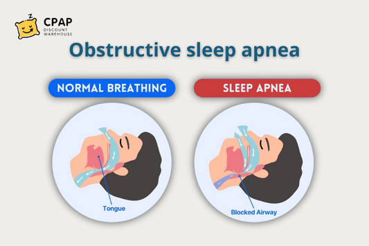 Obstructive Sleep Apnea