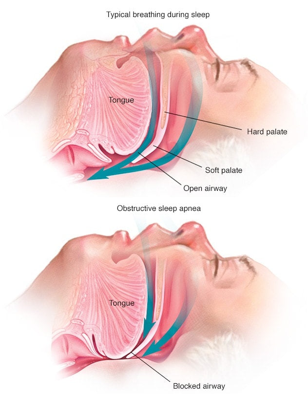 
What is sleep apnea?